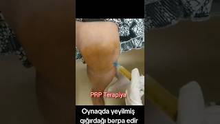 prptherapy dizağrısı arthrosis [upl. by Idonna129]