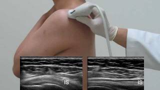 USguided exam and injection of the shoulder 0516 Finalflv [upl. by Yna]