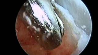 Posterior Arthroscopy with Haglunds Deformity Debridement SFISM [upl. by Woermer198]