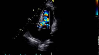 Cardiomyopathie hypertrophique obstructive  image echographique 1 [upl. by Lennod]