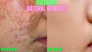 HOW TO LIGHTEN  BRIGHTEN SKIN NATURALLY OVERNIGHT  DIY At Home Face Whitening Remedy 100 WORKS [upl. by Michaeu]