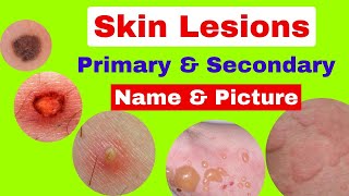 Type of skin lesions with name and picture  Primary and secondary skin lesions  skin diseases [upl. by Retxab]