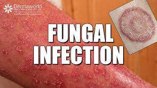 Suffering from Fungal Infection Ringworms WATCH THIS [upl. by Daj541]