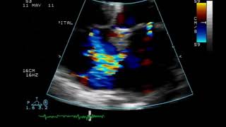 ASD Secundum with left to right Shunt [upl. by Virgina]