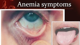 Anemia symptoms [upl. by Jaquiss]