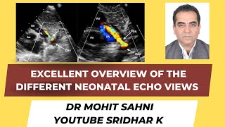 Neonatal echoan excellent overview of how to obtain the basic views Dr Mohit Sahni pocus echo [upl. by Brighton]