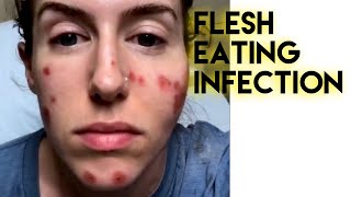 FleshEating Bacterial Infection in my face [upl. by Adiari344]