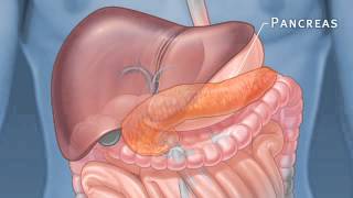 Pancreatic Auto Islet Transplantation with Total Pancreatectomy [upl. by Marten]