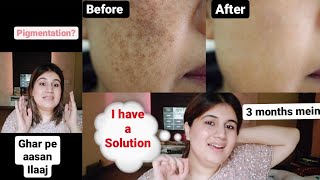 AT HOME BLEMISHES TREATMENT [upl. by Carisa]