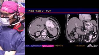 Transradial Radioembolization of HCC with Therasphere Y90 [upl. by Neale]