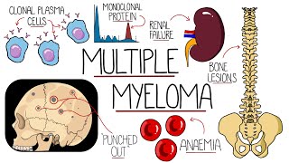 Understanding Multiple Myeloma Multiple Myeloma Explained Clearly [upl. by Cand]