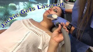 Jackie Gets Lasered Sublative Laser Treatment for Acne Scars [upl. by Viridi]