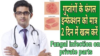 Fungal Infection in Private Parts  Fungal Infection treatment fungalinfectioninprivateparts [upl. by Solokin]