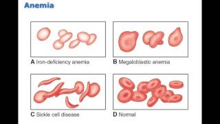 Chapter 13 Disorders of Red Blood Cells BIO216 [upl. by Jak]