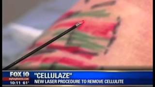 Removing Cellulite with Cellulaze  New Laser Procedure  Paradise Valley Arizona [upl. by Giamo504]