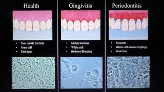 Health Gingivitis Periodontitis Mark Bonner dmd [upl. by Drews48]