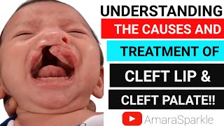 UNDERSTANDING THE CAUSES AND TREATMENT FOR CLEFT LIP AND CLEFT PALATE dentistry trends teeth [upl. by Nnilsia]