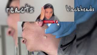 blackhead removal blackheads blackheads new this week blackheads extration blackhead 2024 acne [upl. by Anom]