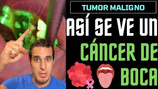 Así se ve un CÁNCER EN LA BOCA  Síntomas TUMOR ORAL maligno shorts [upl. by Glick]