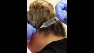 Bilateral Occipital Nerve Block [upl. by Nomit951]