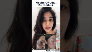 Dermatologist Dr Anvika Reveals The Solution Of Nevus Of Ota [upl. by Proctor]