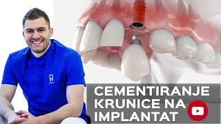 KERAMIČKA KRUNICA NA IMPLANTATU  CEMENTIRANJE KRUNICE  4SMILE [upl. by Asikal]