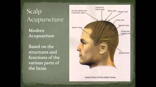 Scalp Acupuncture Overview [upl. by Yahc]