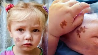 Mom Adopts Girl With Same Birthmark She Shocked When She Sees DNA Test Results [upl. by Oilejor715]