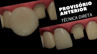 Como fazer dente PROVISÓRIO ANTERIOR com resina acrílica  Técnica Direta da Bola  Temporary Crown [upl. by Jeannie]