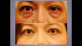 ChaseLayMD Ptosis Droopy Eyelid Surgery [upl. by Atiner381]