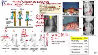 Atresia Esófago [upl. by Megdal]