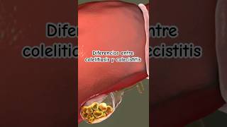 Diferencias entre el dolor por colelitiasis y el dolor por colecistitis  medicina shorts [upl. by Kcirdde]