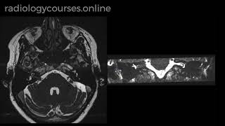 Vestibular Schwannoma [upl. by Elurd501]