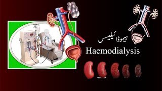 Dialysis ڈایالائی سیس [upl. by Einimod]