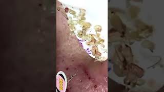 Blackhead Removal Acne Removal Treatment 04 [upl. by Ahsenre]