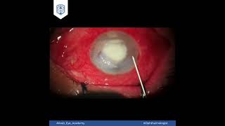 Educational Video 35 Intracorneal stromal injection [upl. by Zaria]