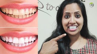 Teeth Whitening  Malayalam  പല്ലുകൾ എളുപ്പത്തിൽ വെളുക്കാൻ [upl. by Assena776]