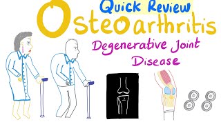 Osteoarthritis OA  Degenerative Joint Disease  Quick Review  Rheumatology Playlist [upl. by Wolpert]