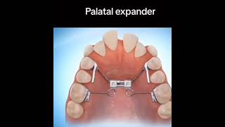 Espansore del palato come funziona [upl. by Ithaman]