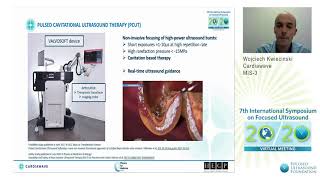 W Kwiecinski  Noninvasive Ultrasound Therapy of Calcific Aortic Stenosis FirstinHuman 2020 [upl. by Rehctelf908]