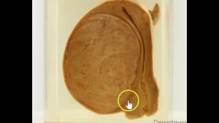 Leiomyoma fibroid grossmicroscopypathology histopathology mbbs uterusproblemeducational [upl. by Kroll]