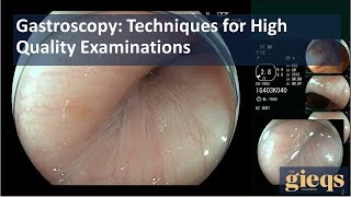 Gastroscopy Techniques for High Quality Examinations [upl. by Wehner]