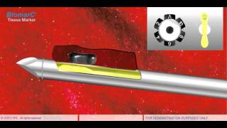 STEREOTACTIC VACUUM BIOPSY VAB [upl. by Icam769]