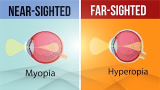 Difference in Myopia and Hyperopia  Nearsighted and FarSighted Lens  Class 10  Letstute CBSE [upl. by Darsie]