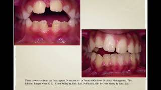 Interceptive orthodontics 1 [upl. by Kimmie803]