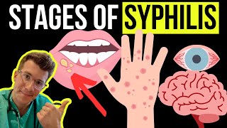 Doctor explains the Symptoms and Stages of SYPHILIS STI [upl. by Acinomahs]