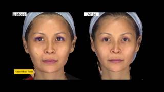 Ellanse procedure at ShangLi Dermatologic amp Aesthetic Clinic [upl. by Ertsevlis]