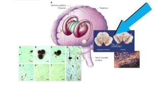 Curing Parkinsons by transplanting cells [upl. by Onaicram293]