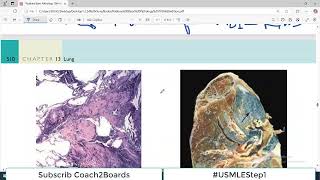 Chp13 Robbins Patho  Lung Pathology  Coal Worker Pneumoconiosis  Restrictive Lung Disorders [upl. by Alpers]