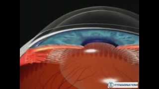 GLAUCOMA DE ANGULO CERRADO E IRIDOTOMIA LASER [upl. by Enayd772]